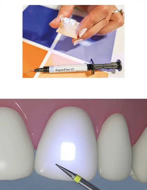 Aligner Flow LC composito ortodonzia VOCO - immagine 2