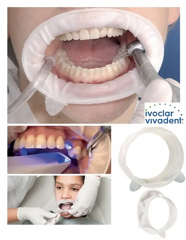 Optragate apribocca monouso Ivoclar - immagine 2